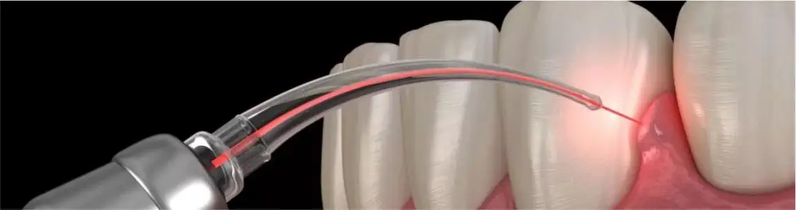 periodontics and gums treatments by DentaCrest in punjabi bagh and rajouri garden